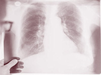 India recorded highest TB cases in 2014: WHO